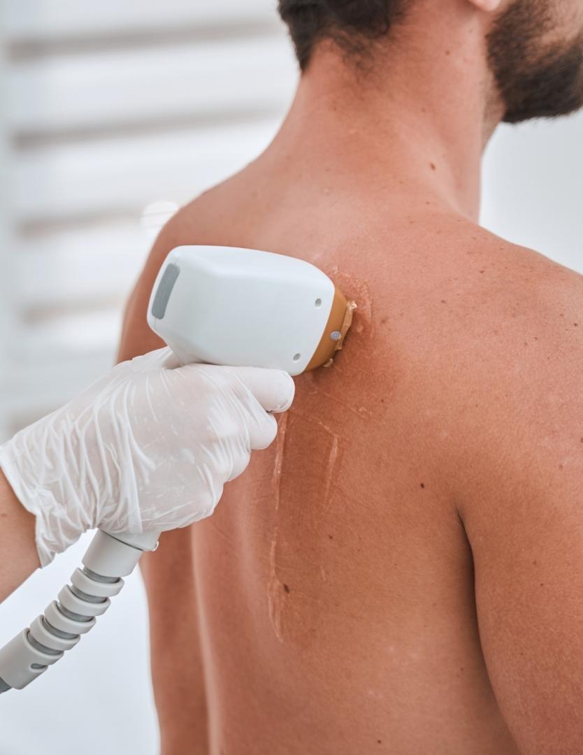 DEPILACIÓN LÁSER ESPALDA   PECHO   LUMBARES   ABDO DULCE CALVO para Unisex | Dulce Calvo