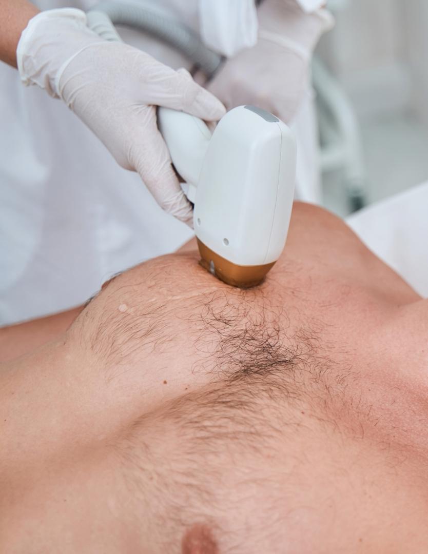 DEPILACIÓN LÁSER PECHO   ABDOMEN DULCE CALVO para Unisex | Dulce Calvo